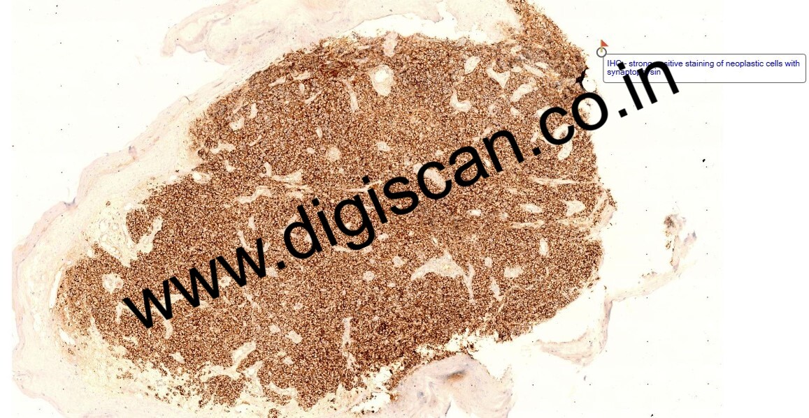 MDS Immunohistochemistry (IHC) Digital Slides Set